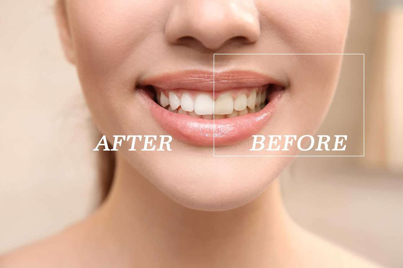 How Can You Maintain a Consistent Smile Shade with Crowns Harlow?