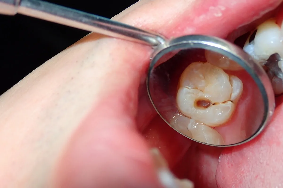 Why Do Teeth Crack? Common Causes to Know Harlow
