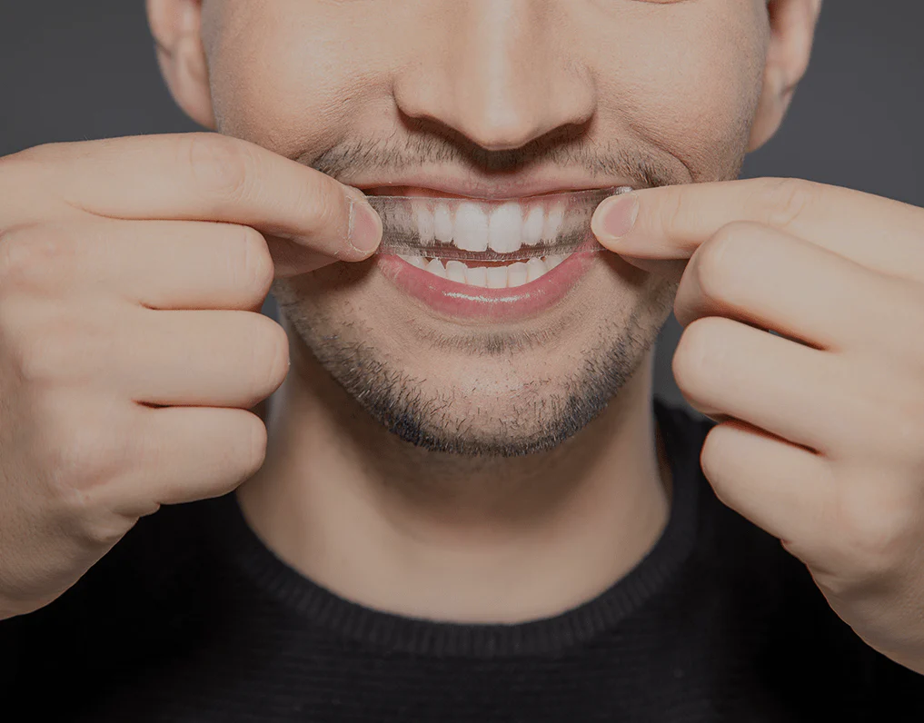 What to Consider Before Choosing a Teeth Whitening Option Harlow