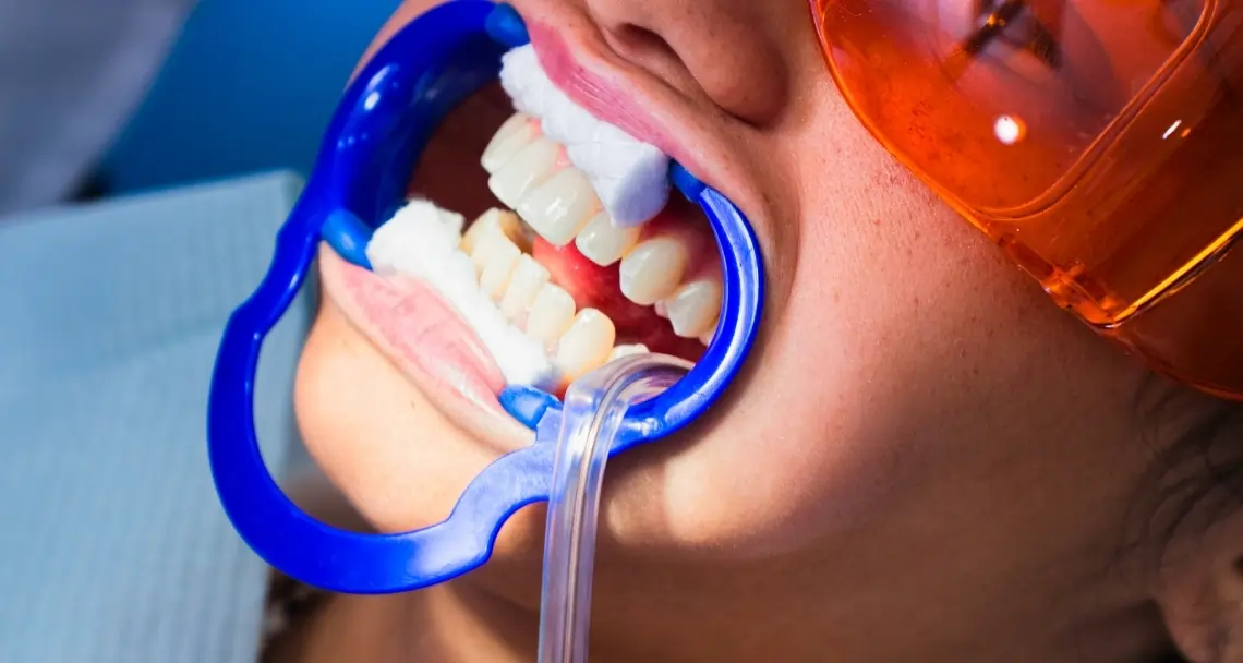 Why At-Home Laser Teeth Whitening Is Faster Harlow