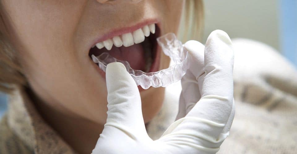 Why Bleaching Trays Require More Time Harlow